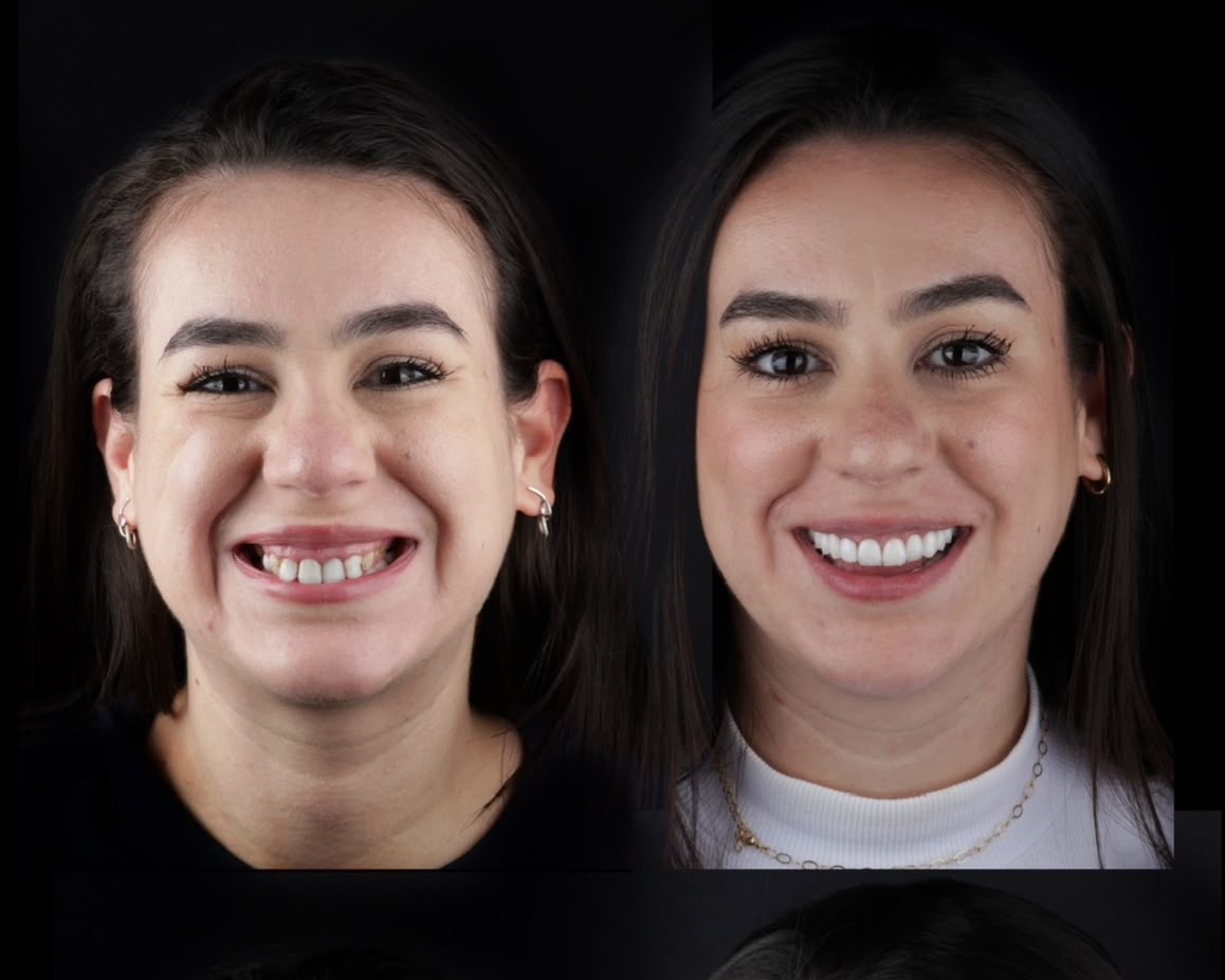 Antes e depois: lentes de contato em porcelana no arco superior