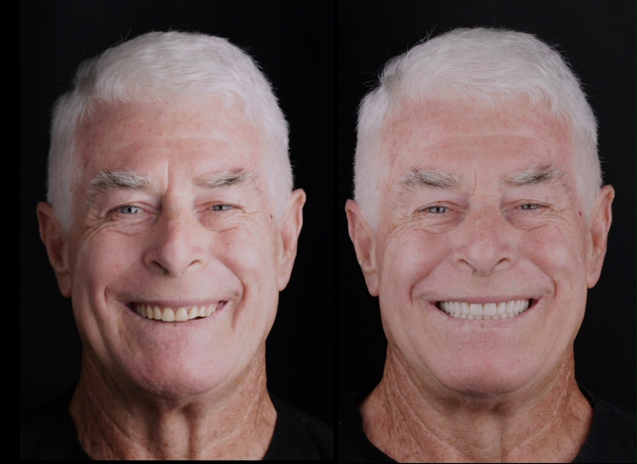 Antes e depois: lentes de contato nos arcos superior e inferior